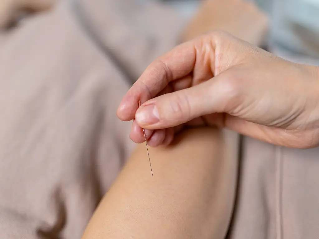 Nahaufnahme einer Hand, die vorsichtig eine Akupunkturnadel in den Arm einer Person einführt, die auf einer beigen Unterlage liegt.